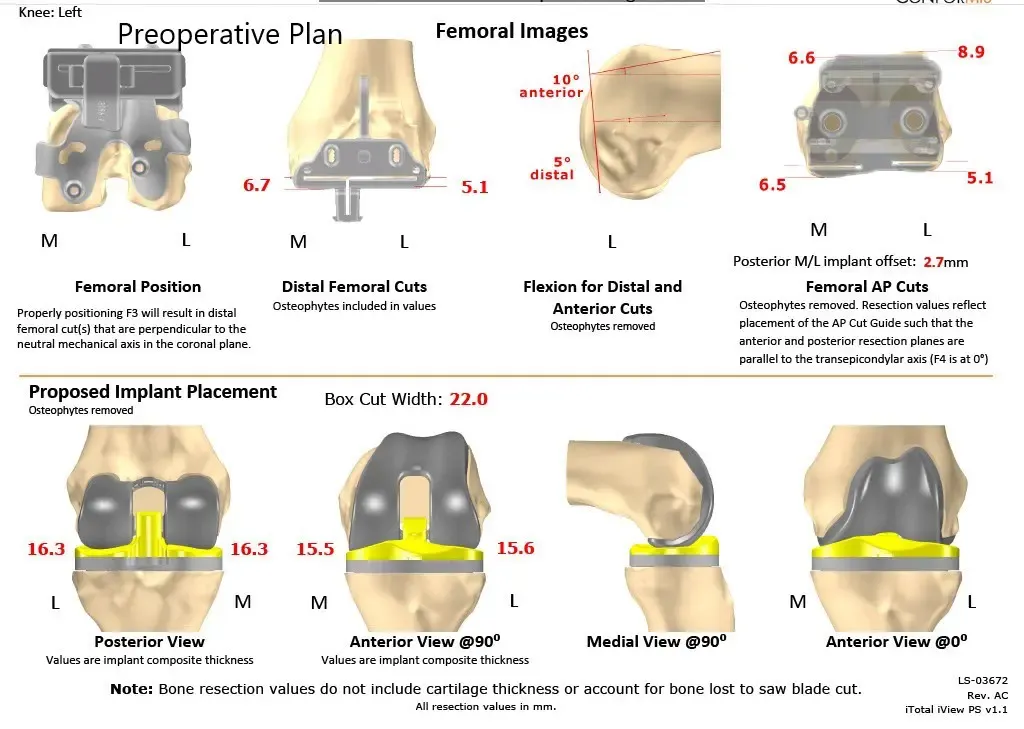 Complete Orthopedics patient specific surgical plan for a Custom Left Knee Replacement in a 40 year male - scan 2