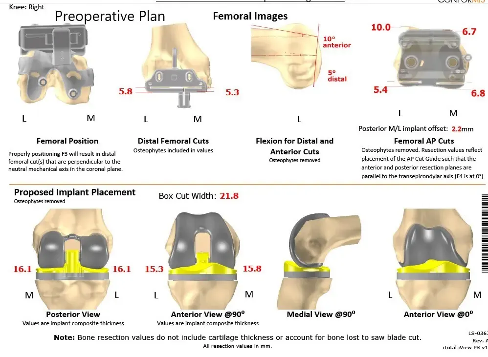 Plan quirúrgico completo específico para pacientes de Ortopedia para una artroplastia personalizada de rodilla derecha total - hombre de 62 años - escaneo 2