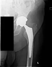 Radiografía preoperatoria de la cadera izquierda vista de la AP que muestra una fractura femoral periprotésica (desplazada mínimamente a lo largo de la parte medial del miembro femoral proximal) con hundimiento del tallo