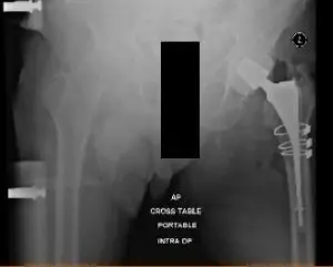 Postoperative X-ray showing AP view of pelvis with both hips, Left Hip has cerclage wires and antibiotic spacer in situ