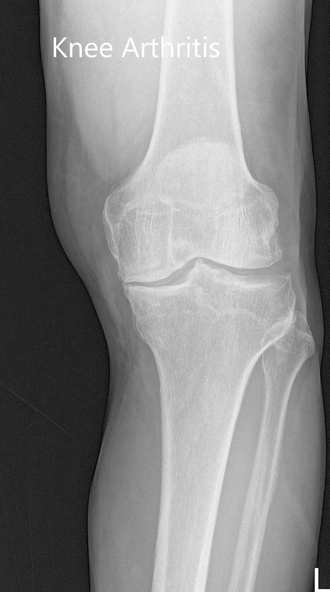 Preoperative X-ray of the left knee showing AP and lateral views