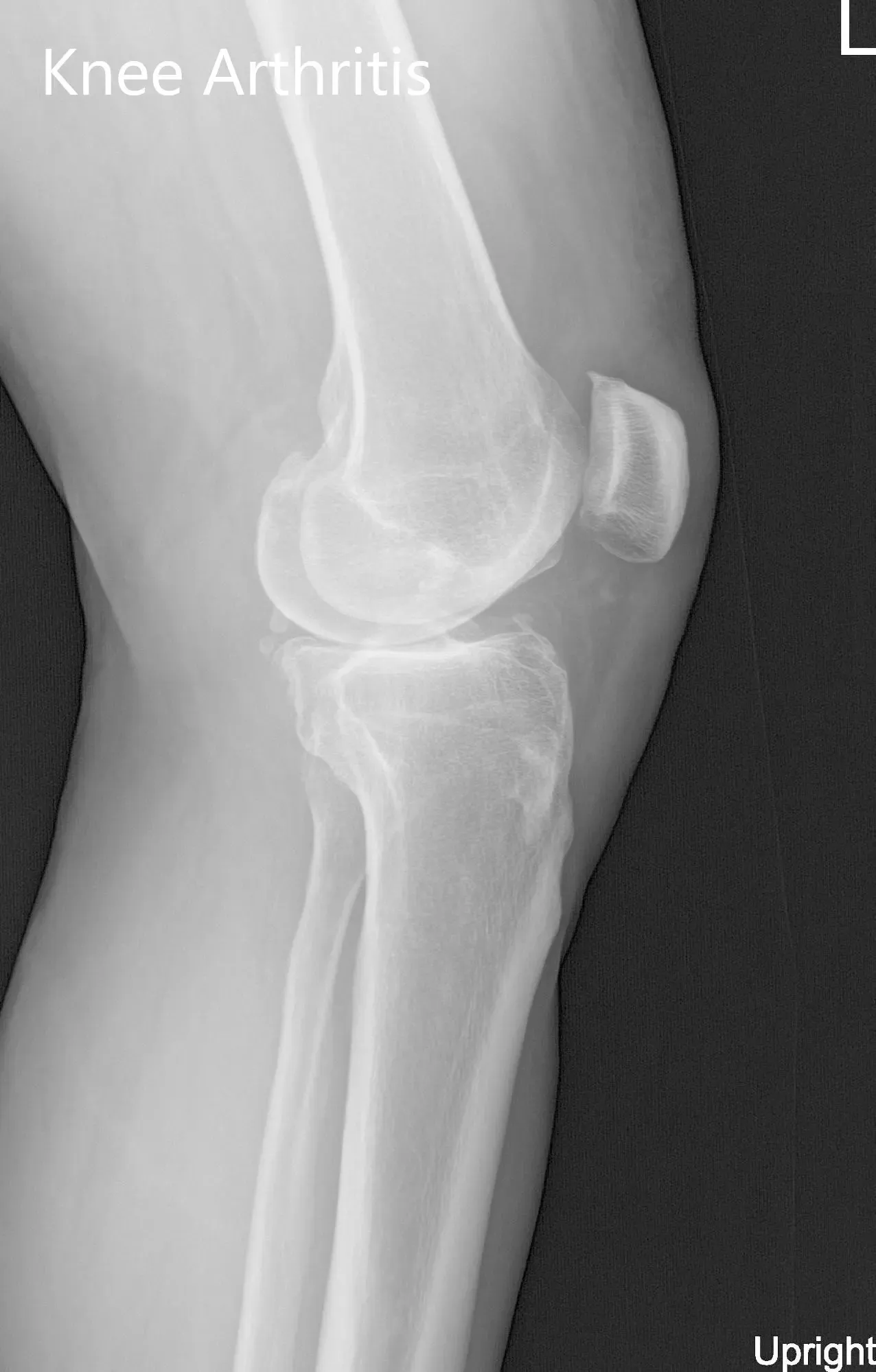 Preoperative X-ray of the left knee showing AP and lateral views - img 2