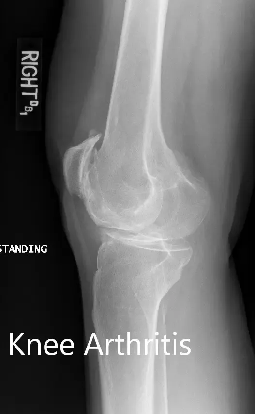 Radiografía preoperatoria que muestra las vistas laterales de la rodilla derecha e izquierda respectivamente