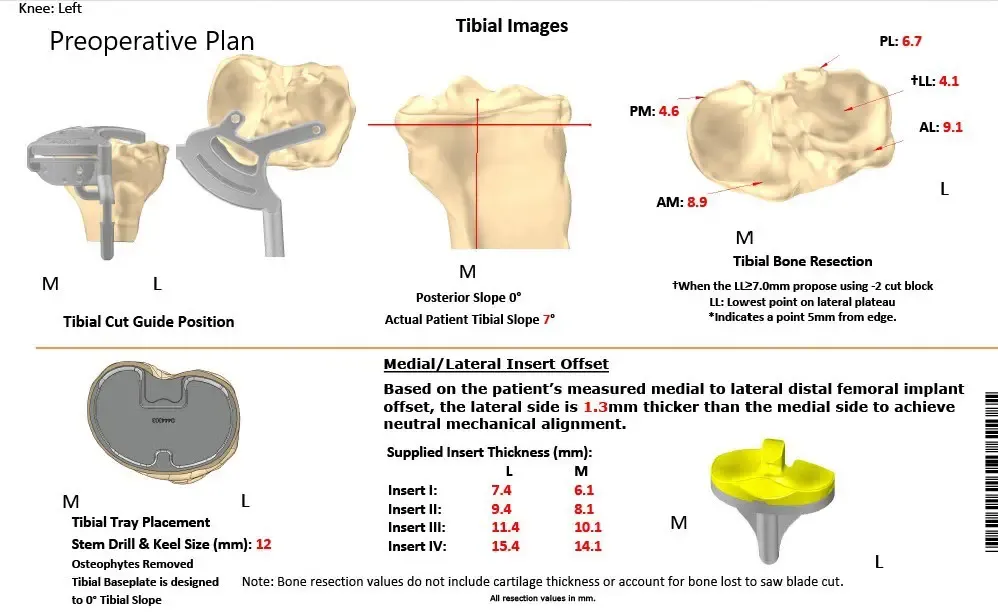 Plan quirúrgico completo específico para pacientes de Ortopedia para un reemplazo bilateral personalizado de rodilla total en un hombre de 61 años con artritis de rodilla y deformidad de género valgum
