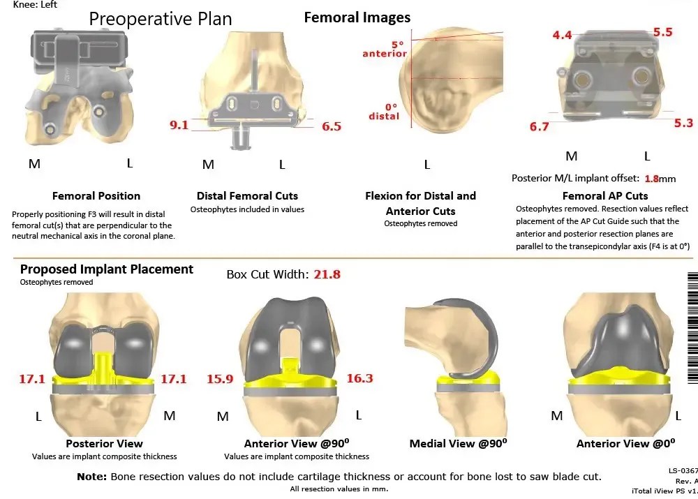 Plan quirúrgico completo específico para paciente en ortopedia para un reemplazo bilateral personalizado total de rodilla en un hombre de 61 años con artritis de rodilla y deformidad de género valgum - escaneo 2