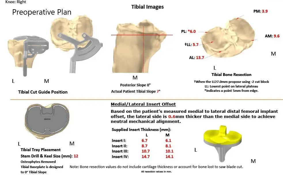 Plan quirúrgico específico para paciente de Ortopedia Completa para un reemplazo bilateral personalizado de rodilla total en un hombre de 61 años con artritis de rodilla y deformidad de Genu Valgum - ecografía 3