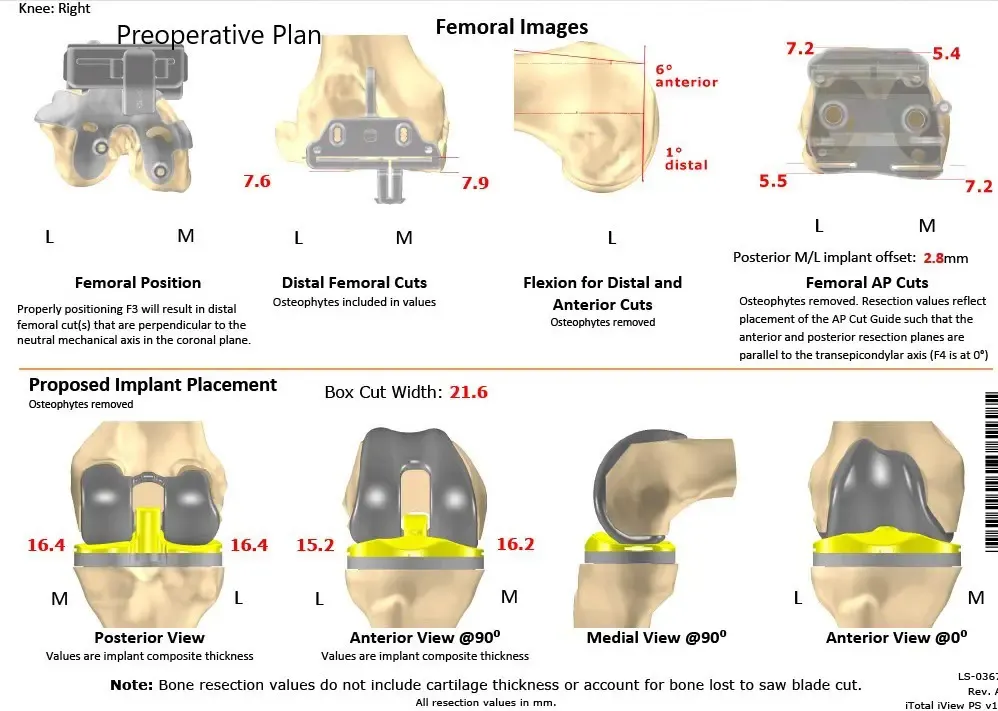 Plan quirúrgico completo específico para pacientes en ortopedia para un reemplazo bilateral personalizado de rodilla total en un hombre de 61 años con artritis de rodilla y deformidad de género valgum - ecografía 4