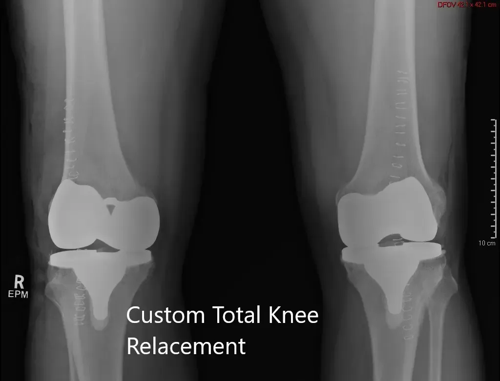 Postoperative X-ray showing the AP view of both knees