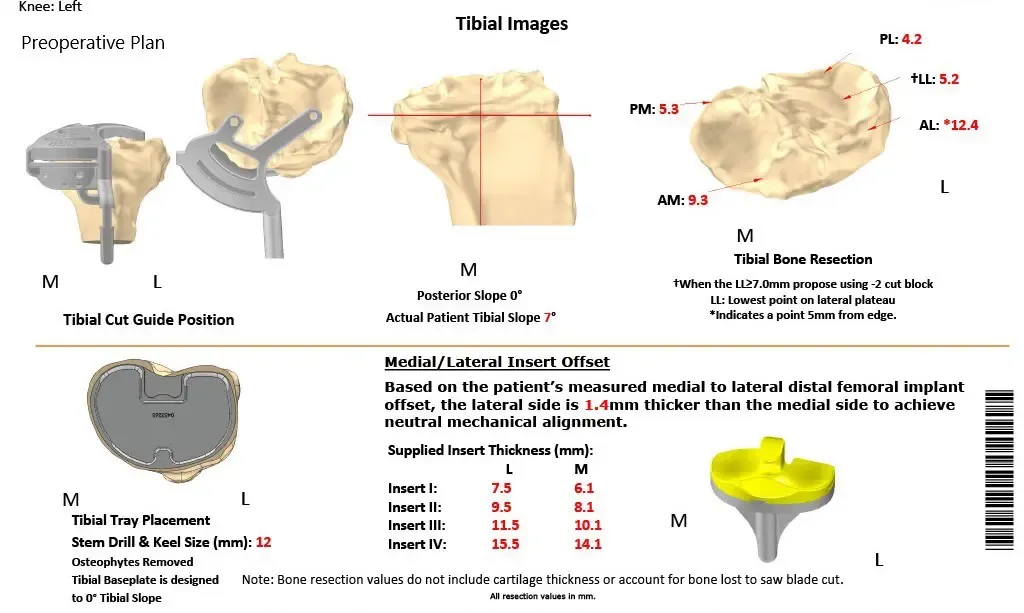 Complete Orthopedics patient specific surgical plan for a Custom Left Knee Total Replacement in a 68-year-old Female