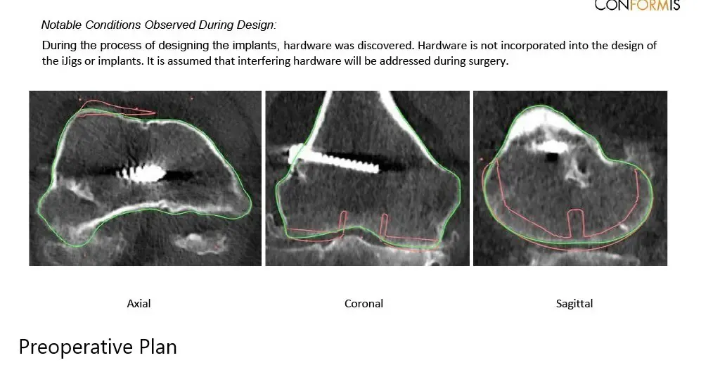 Radiografía preoperatoria que muestra la vista AP y lateral de la rodilla derecha con tornillos retenidos, consistentes con la reconstrucción del LCA - img 3