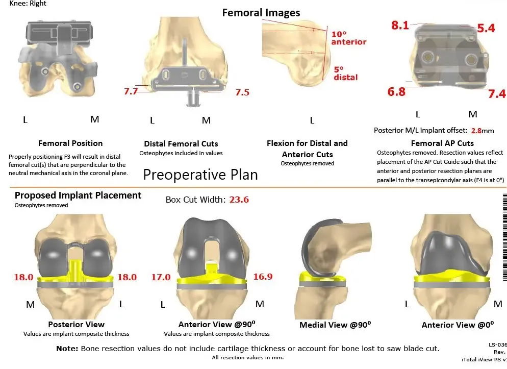 Plan quirúrgico completo específico para pacientes en ortopedia para un reemplazo total personalizado de rodilla derecha en una mujer de 55 años con reconstrucción previa del LCA - ecografía 2