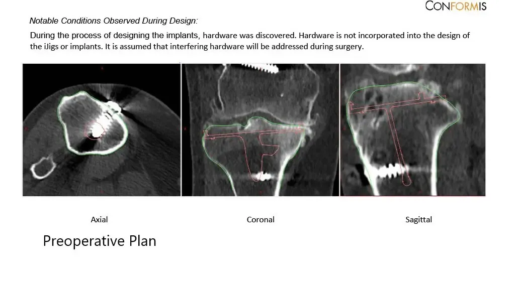 Radiografía preoperatoria que muestra la vista AP y lateral de la rodilla derecha con tornillos retenidos, consistentes con la reconstrucción del LCA - img 3
