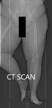 Topographic CT images of the weight-bearing Right and Left knee respectively