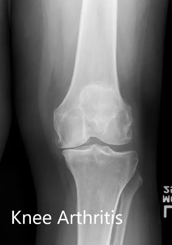 Preoperative X-ray of the left knee showing AP and lateral views Preoperative X-ray of the left knee showing AP and lateral views