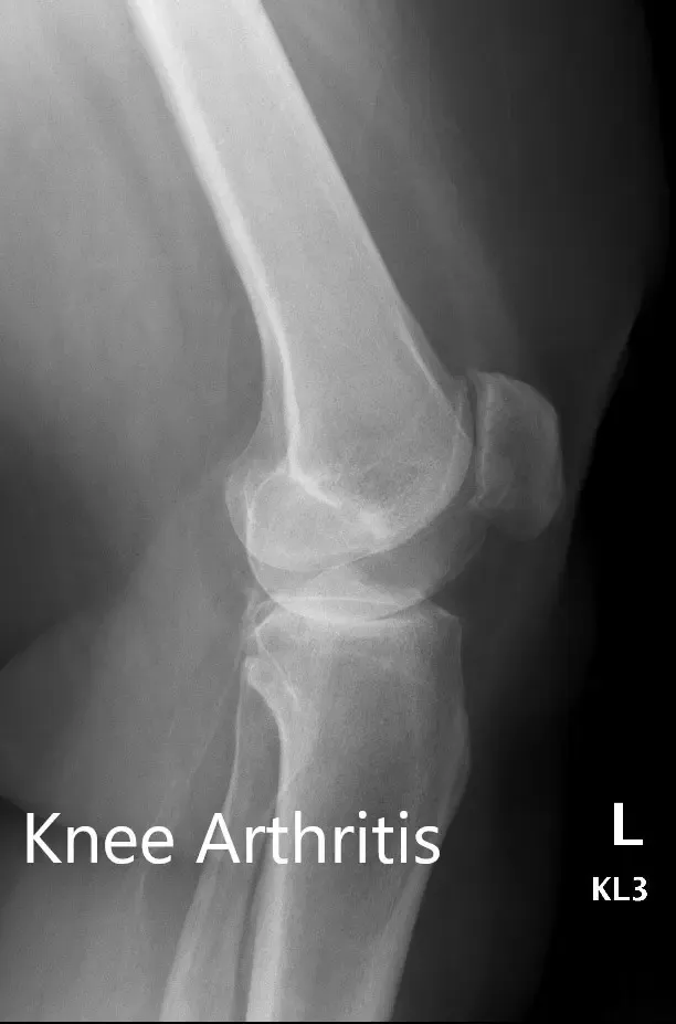 Preoperative X-ray showing the AP and lateral views of the left knee - img 2 Preoperative X-ray showing the AP and lateral views of the left knee - img 2