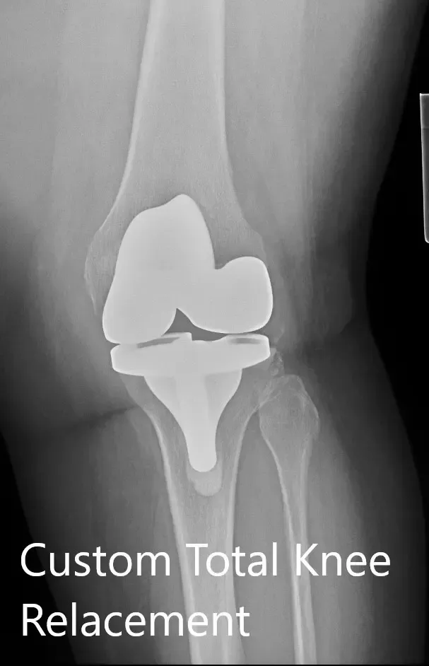 Postoperative X-ray showing the AP and lateral view of the left knee Postoperative X-ray showing the AP and lateral view of the left knee