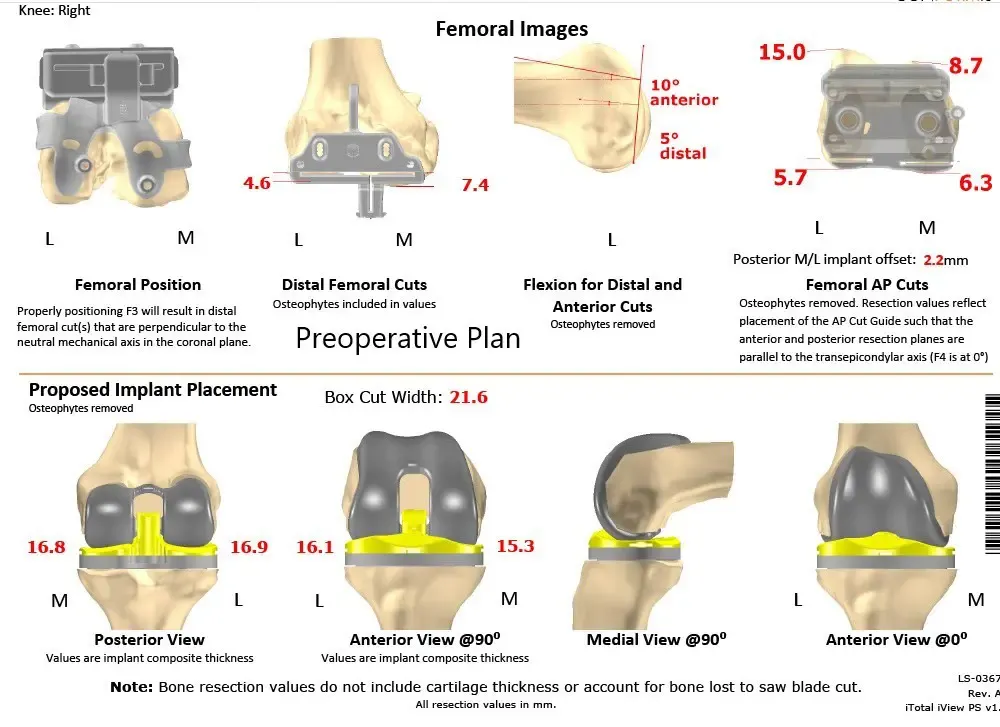 Plan quirúrgico completo específico para pacientes de Ortopedia para un reemplazo personalizado de rodilla derecha en un paciente de 72 años - escaneo 2