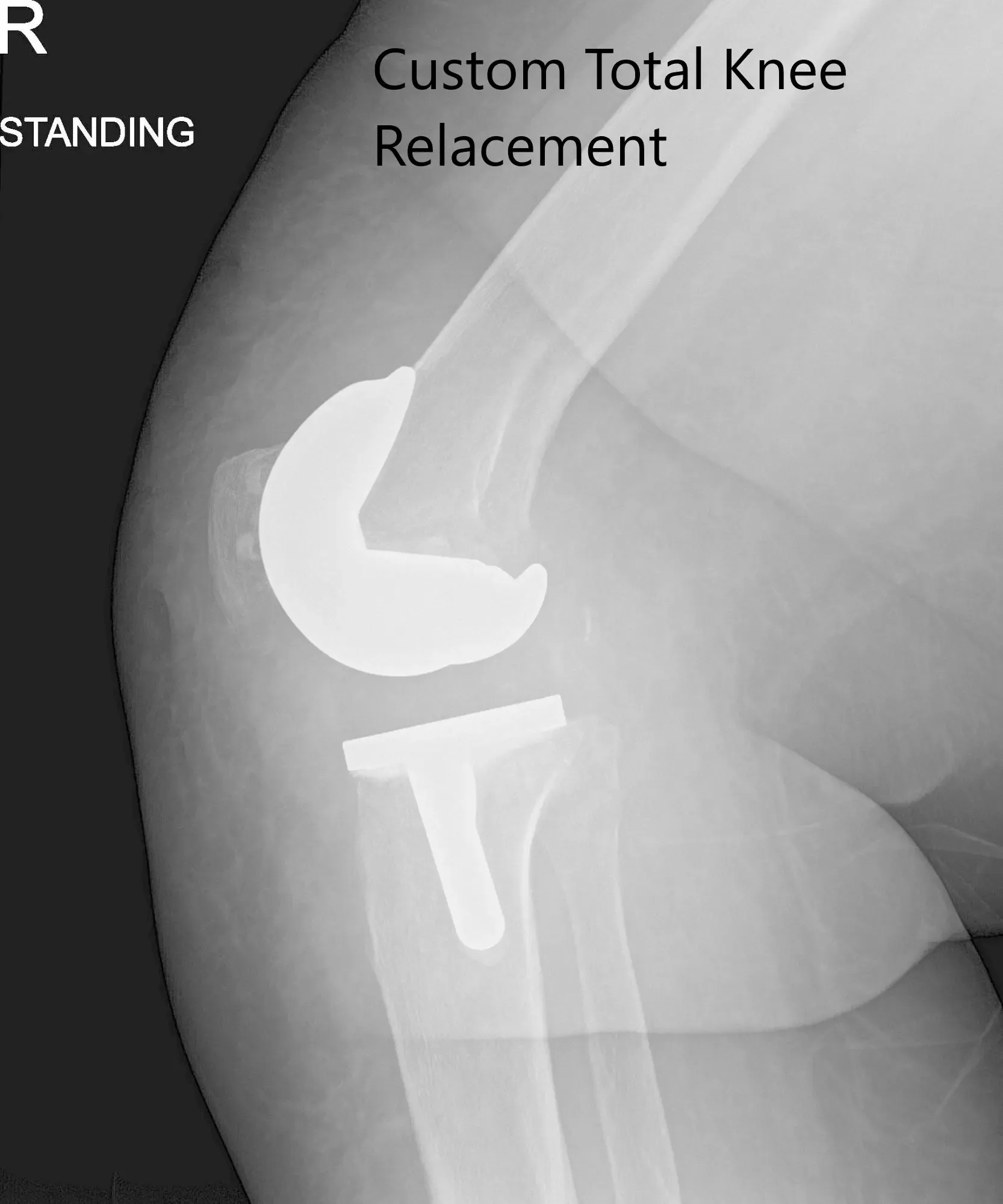Imágenes de radiografías postoperatorias que muestran vistas AP y laterales de la rodilla derecha - IMG 2