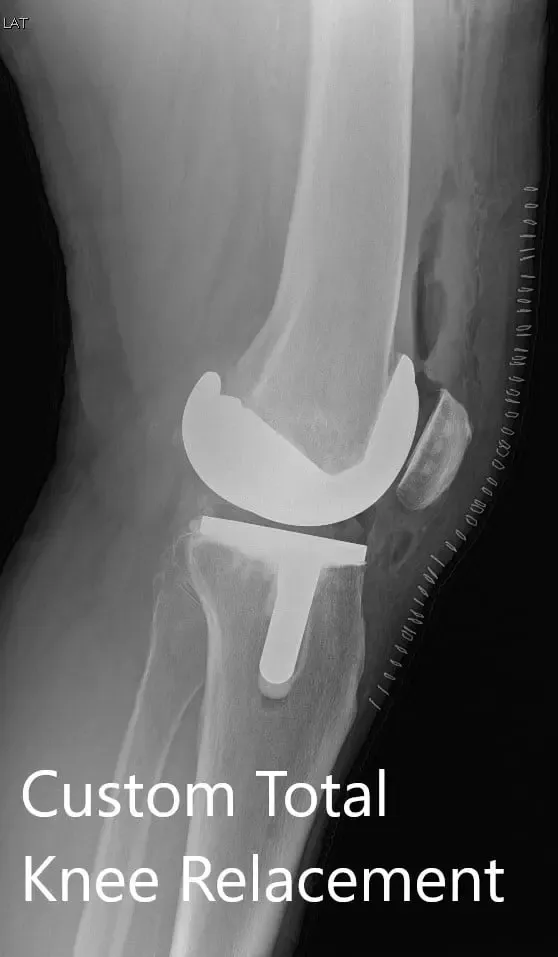 Postoperative X-ray showing AP and lateral views of the right knee - img 2 Postoperative X-ray showing AP and lateral views of the right knee - img 2