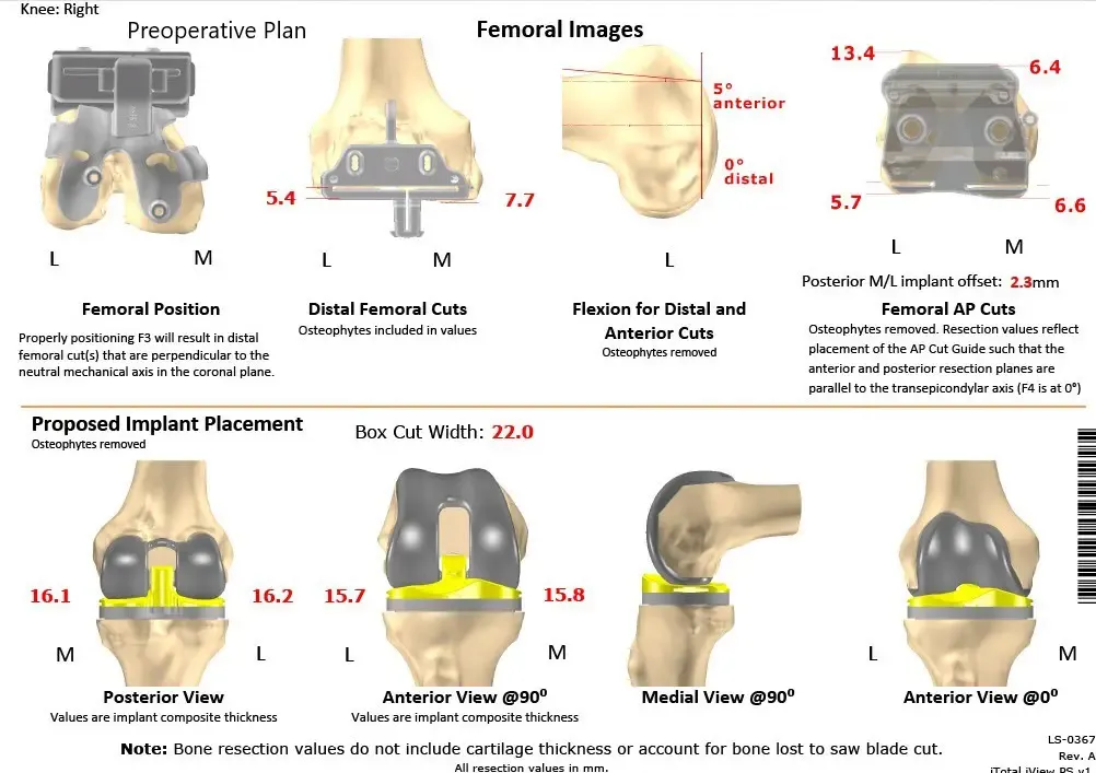Plan quirúrgico completo específico para pacientes en ortopedia para un reemplazo personalizado de rodilla derecha en un hombre de 73 años con artritis