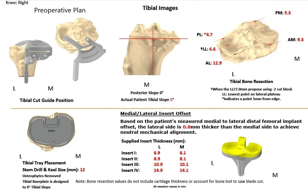Plan quirúrgico completo específico para pacientes en Ortopedia para un reemplazo total personalizado de rodilla derecha en un hombre de 73 años con artritis - ecografía 2