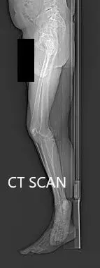 Imágenes topográficas de tomografía computarizada preoperatoria - IMG 2 Imágenes topográficas de tomografía computarizada preoperatoria - IMG 2