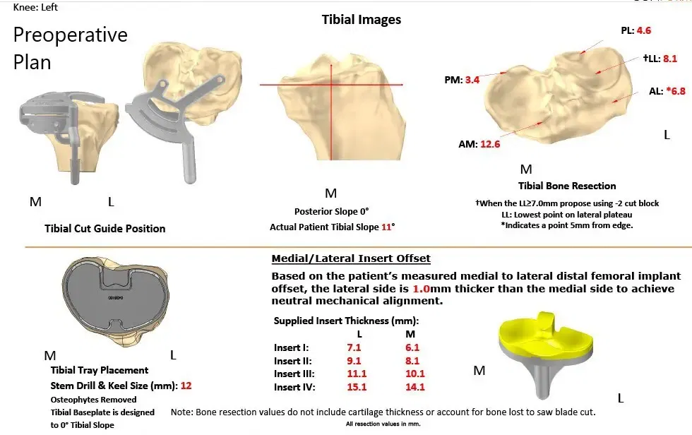 Plan quirúrgico completo específico para pacientes en ortopedia para un reemplazo total de rodilla personalizado izquierdo en una mujer de 74 años