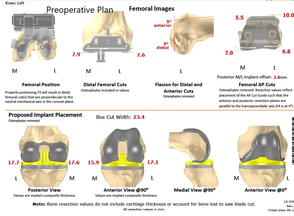 Plan quirúrgico completo específico para pacientes en ortopedia para un reemplazo total de rodilla personalizado izquierdo en una mujer de 74 años - escaneo 2