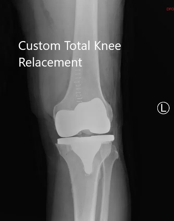 Radiografía postoperatoria de la rodilla izquierda que muestra vistas laterales y AP - img 2 Radiografía postoperatoria de la rodilla izquierda que muestra vistas laterales y AP - img 2