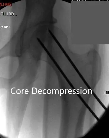 Anteroposterior view of the left hip showing pre-collapse avascular necrosis of the left hip