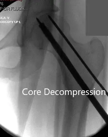 Core Decompression at the site of avascular necrosis