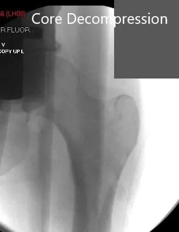 Postoperative image after core decompression and injection of stem cell harvest