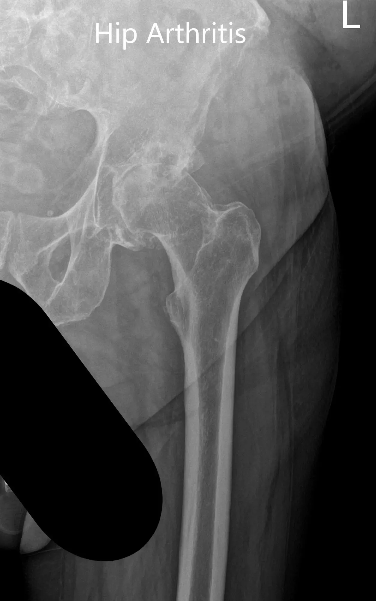 Radiografía preoperatoria que muestra la vista lateral en forma de rana y la vista en ángulo de la cadera izquierda - img 2