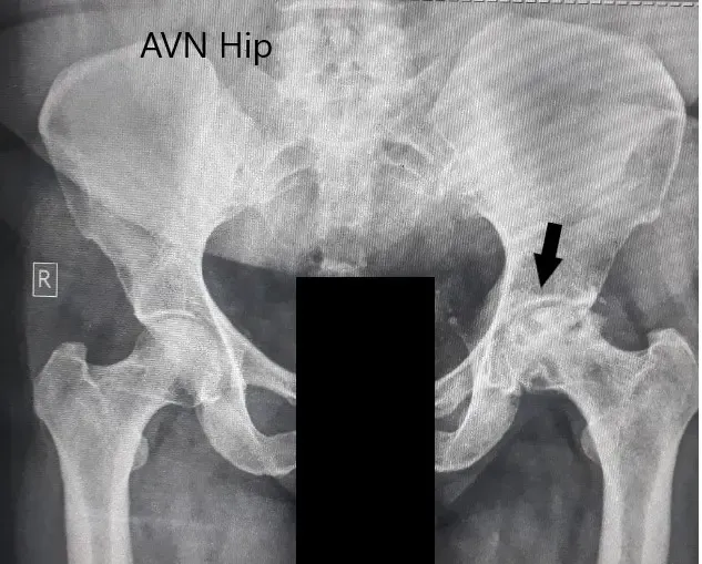 Radiografía preoperatoria de la pelvis con ambas caderas en vista anteroposterior que muestra cambios en el AVN en la cadera izquierda