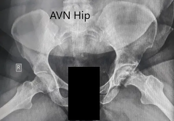 Radiografía preoperatoria de la pelvis con ambas caderas en la vista lateral con patas de rana mostrando cambios en el AVN en la cadera izquierda