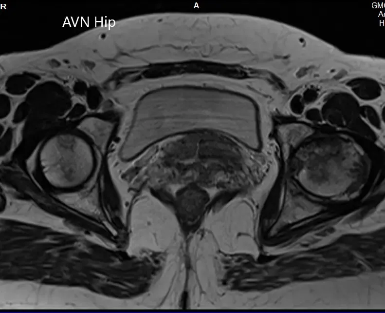 T1WI de la resonancia magnética que muestra una sección axial de la cabeza femoral bilateral
