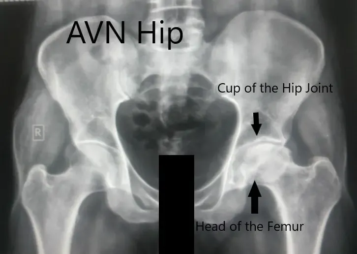 Anteroposterior view of the pelvis with both hips Anteroposterior view of the pelvis with both hips