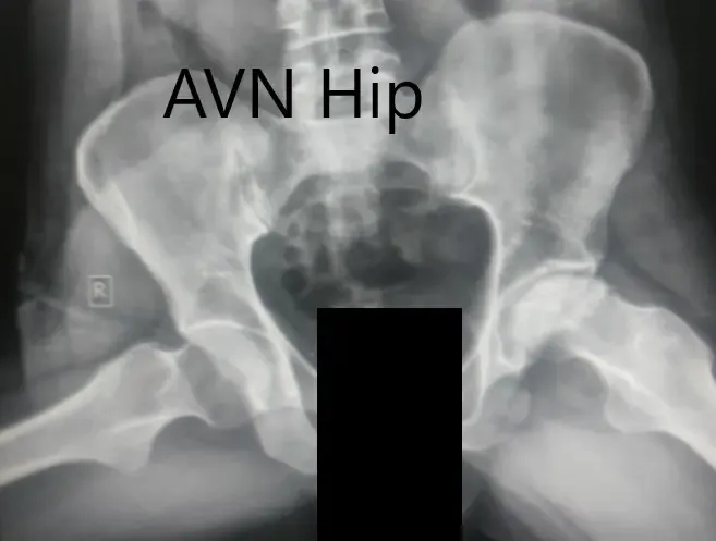 Frog-legged lateral view of both the hip joints Frog-legged lateral view of both the hip joints