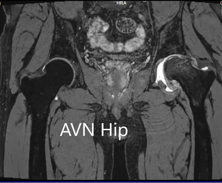 MRI images showing avascular necrosis of the left hip with collapse -scan 3