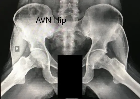 Radiografía preoperatoria de la pelvis con ambas caderas en la vista lateral con patas de rana mostrando el AVN de las caderas bilaterales