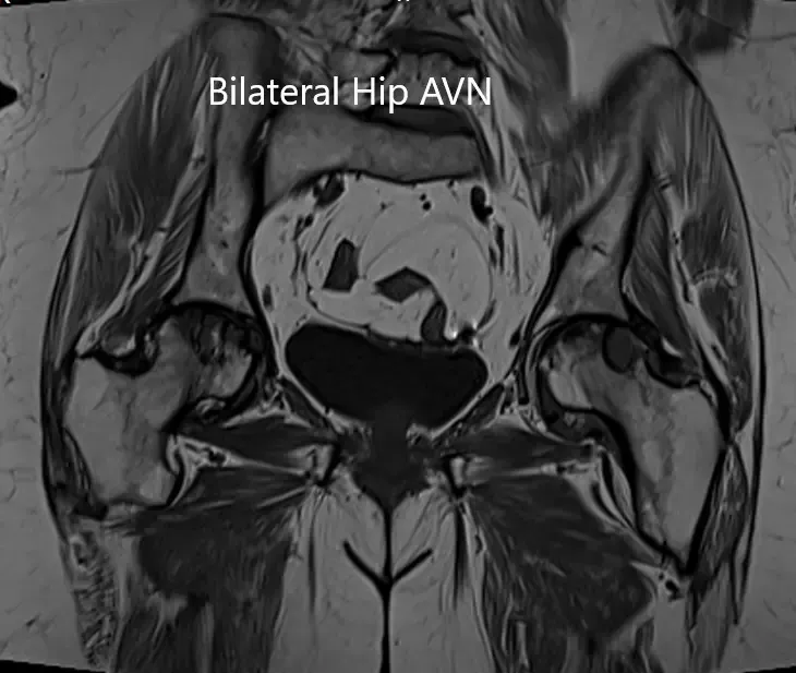 Coronal section of T2WI of pelvis MRI