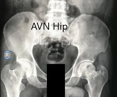 Radiografía preoperatoria de la pelvis con ambas caderas en vista anteroposterior que muestra el AVN de la cadera izquierda