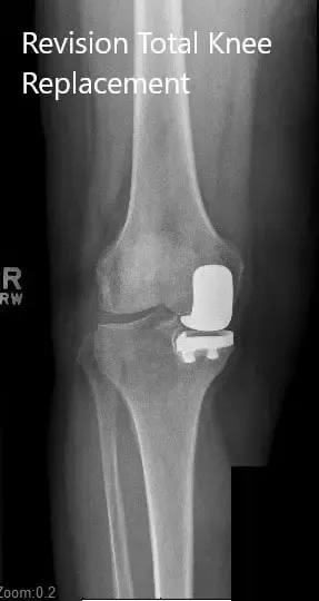 Radiografía preoperatoria de la rodilla derecha en vistas anteroposterior y lateral - img 2