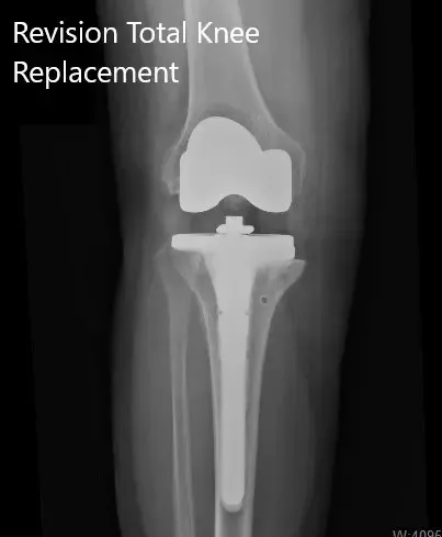 Radiografía postoperatoria que muestra las vistas lateral y anteroposterior de la rodilla derecha - img 2