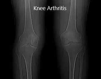 Radiografía preoperatoria que muestra la vista AP de las articulaciones bilaterales de la rodilla