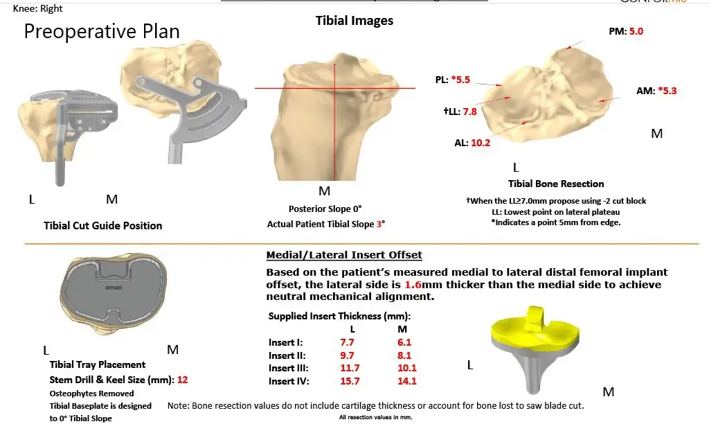 Plan quirúrgico completo de ortopedia específico para un reemplazo de rodilla Right Custom en un hombre de 59 años