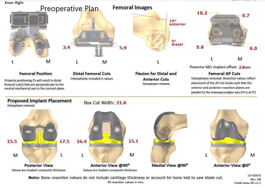 Plan quirúrgico completo específico para pacientes de Ortopedia para un reemplazo de rodilla personalizado derecho en un hombre de 59 años - escaneo 2