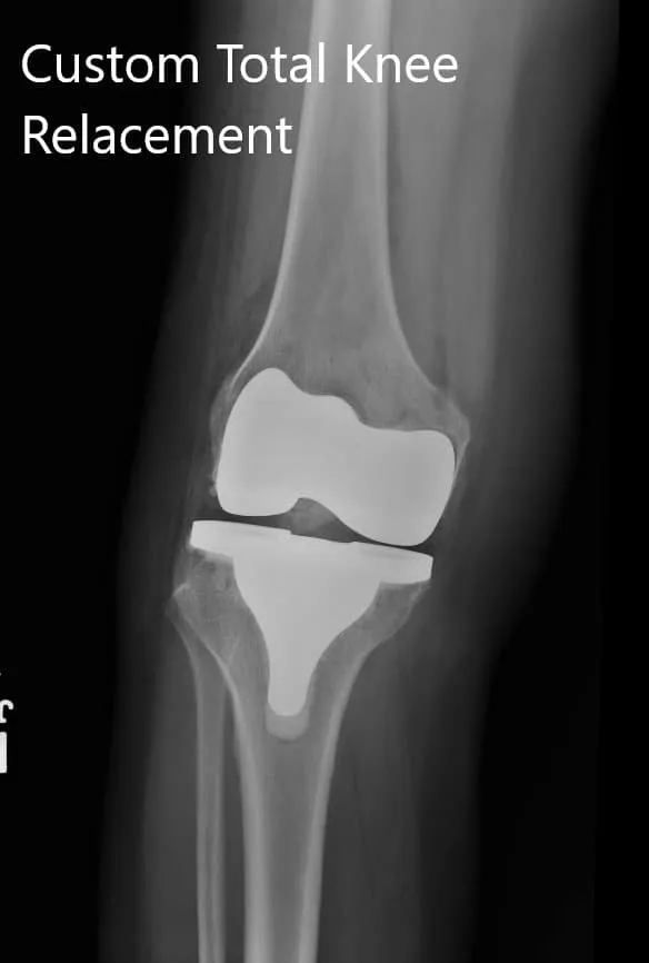 Imágenes postoperatorias que muestran vistas AP y oblicuas de la rodilla derecha