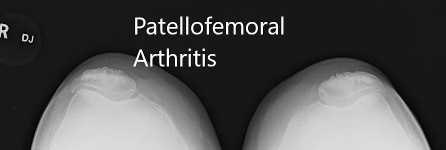 Radiografía preoperatoria que muestra la visión AP y lateral de la articulación de la rodilla derecha, y vista del horizonte de ambas articulaciones - IMG 3