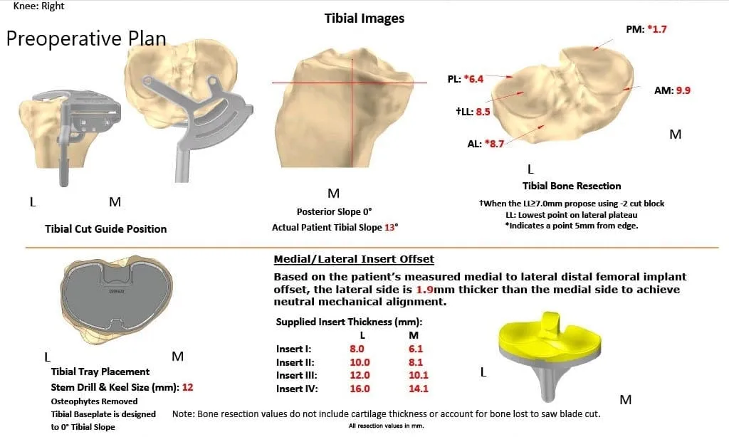 Plan quirúrgico completo específico para pacientes de Orthopedics para un reemplazo total de rodilla Right Custom en una mujer de 68 años